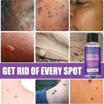 SKIN WART REMOVER - Image 3